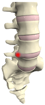 Chiropractic and disc herniation